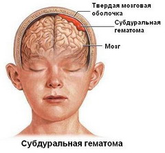 Внутричерепная гематома — скопление крови в полости черепа